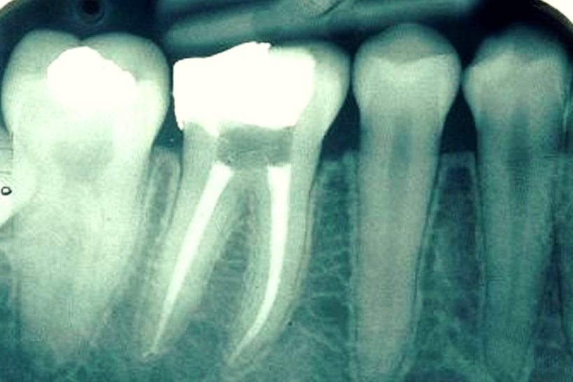 successful root canal treatment