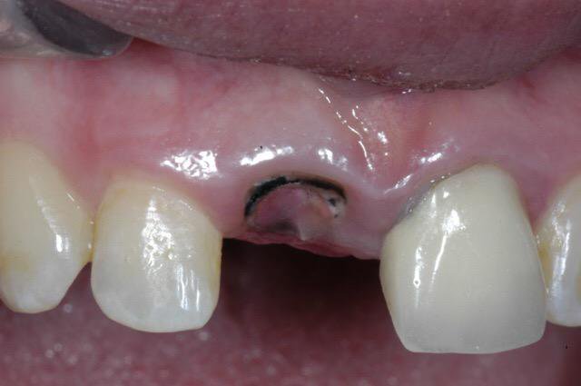 tooth with advance coronal destructions