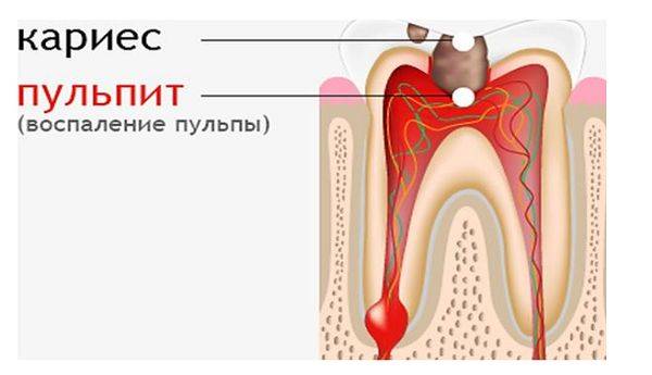 воспаление сосудисто-нервного пучка зуба