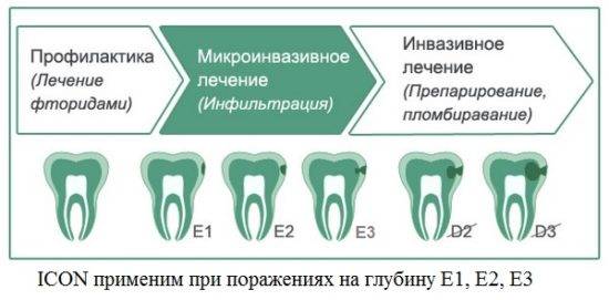 lechenie-zubov-bez-sverleniya-gelem