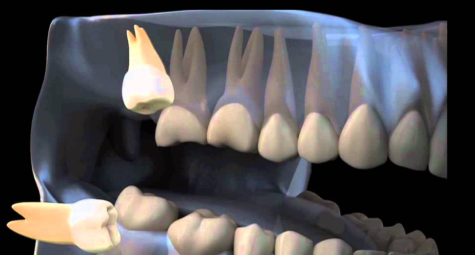 Как выглядит дистопированный зуб?
