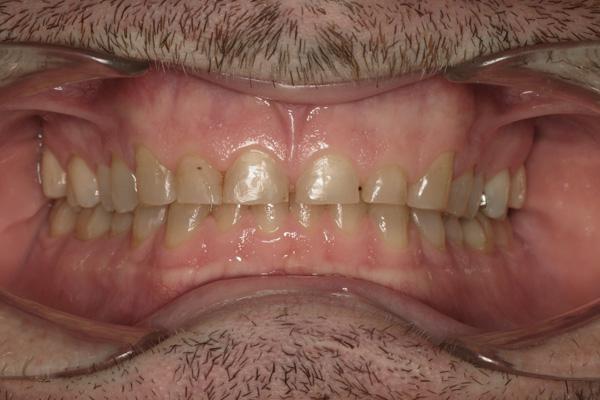 Как выглядит стираемость зубов?