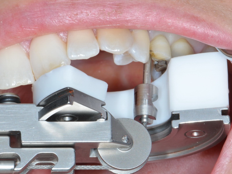 This Innovative Tool Could be the Answer to Pain-Free Tooth Extractions This Innovative Tool Could be the Answer to Pain-Free Tooth Extractions