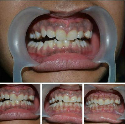 Dental Caries Treatment Laser