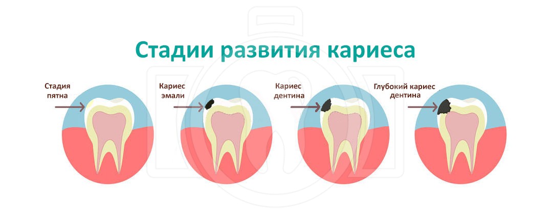 Кариес крым карта