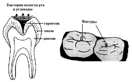 Фиссуры зубов схема