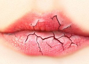 Как питаться при трещинах на губах