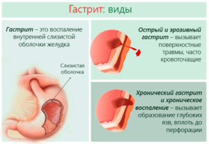 Гастрит