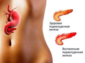 Горечь во рту и налёт может возникнуть при воспалении поджелудочной железы 
