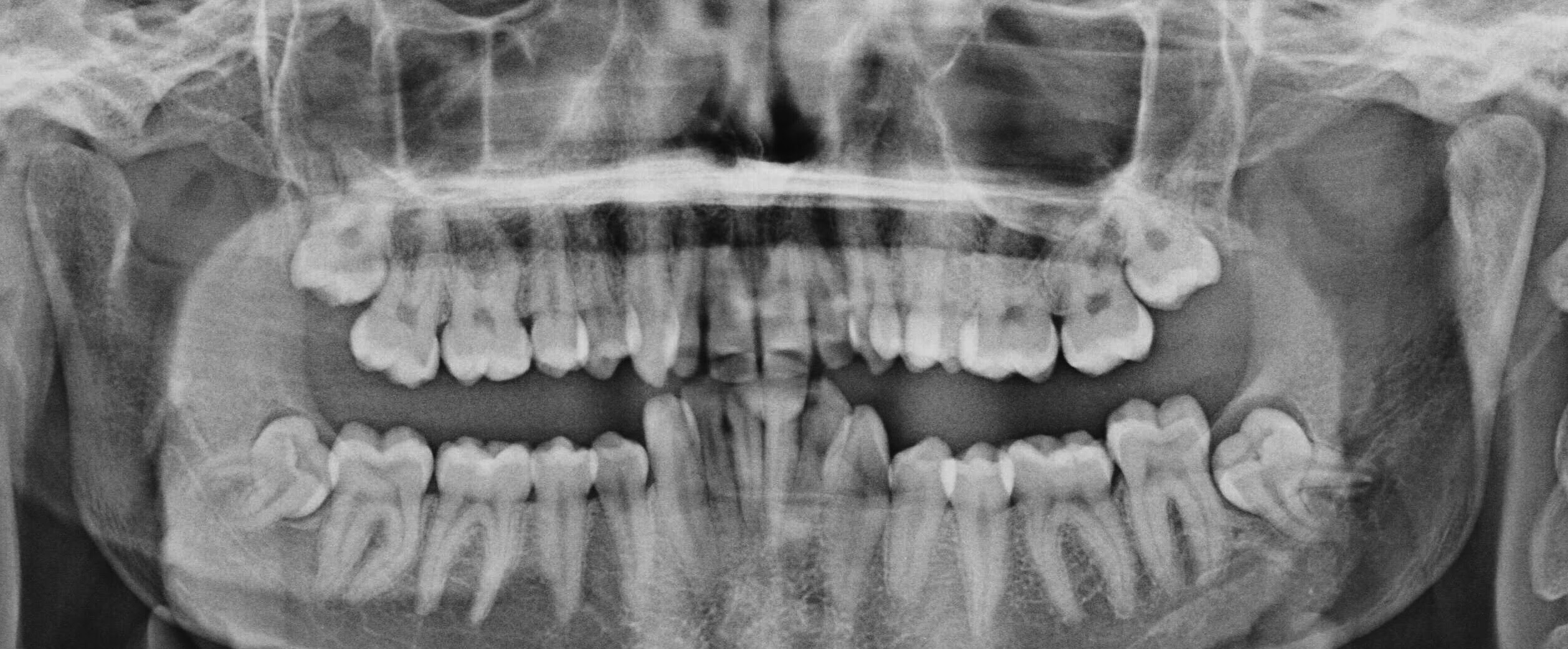 Удаление второго моляра нижней челюсти. Ретинированный зуб мудрости снимок. Ратированные зубы мудрости. Ретинированный зуб мудрости рентген.