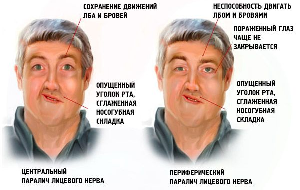 Асимметрия лица