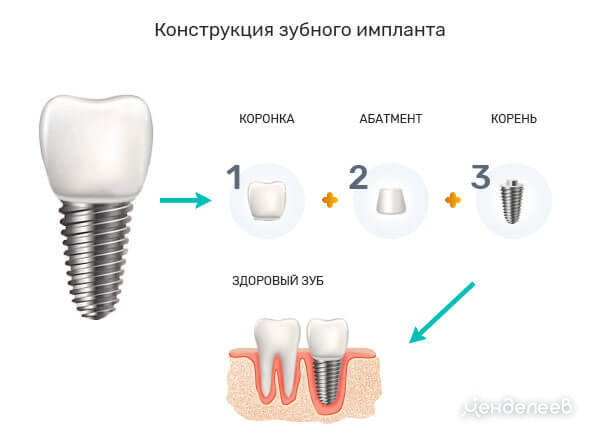 Абатмент на имплант что это. Составные части импланта зуба. Абатмент на имплант. Имплант с коронкой схема.