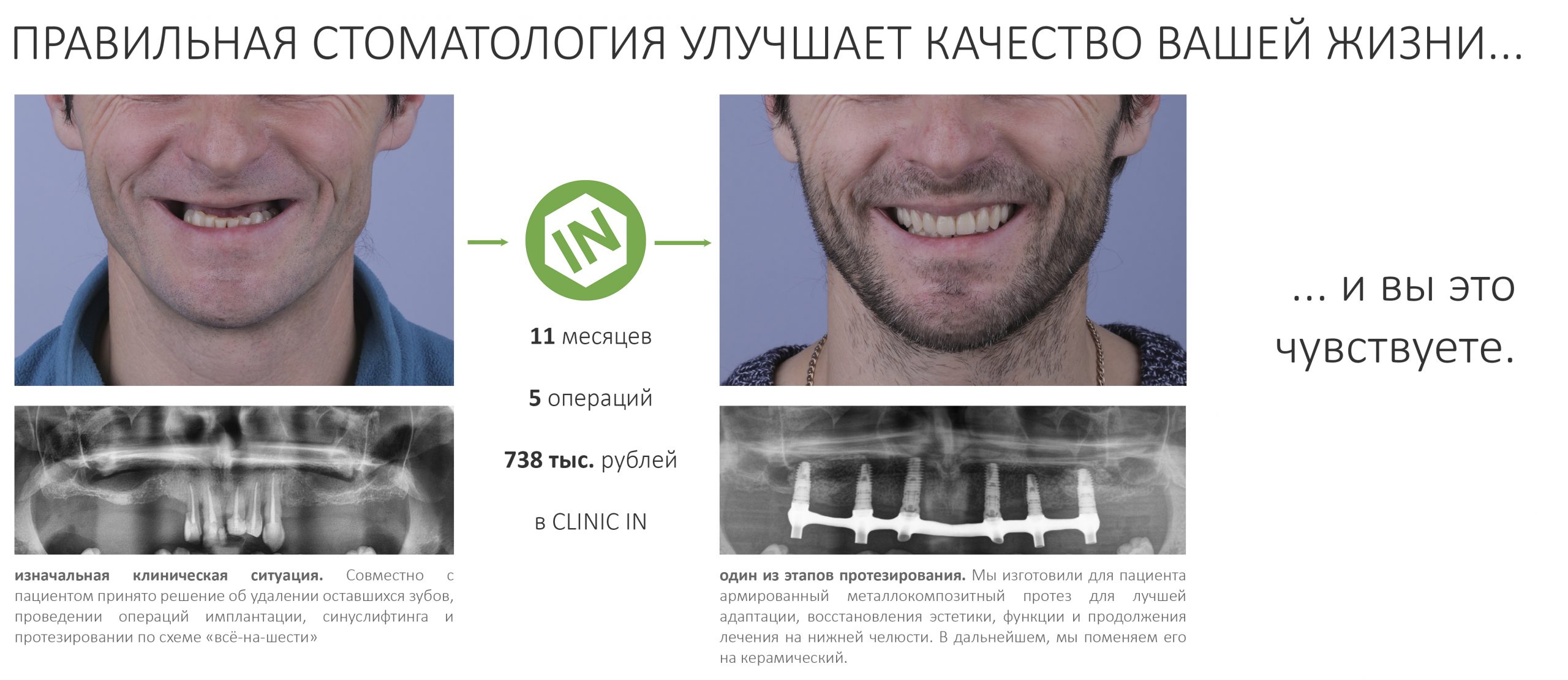 Установка импланта зуба отзывы пациентов. Этапы имплантации и протезирования.