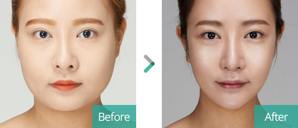 jaw reduction surgery