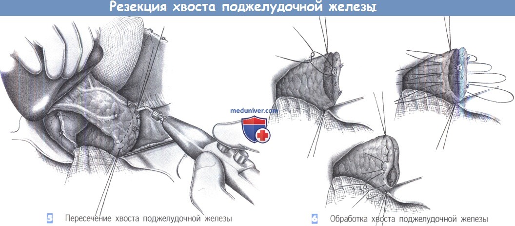 Хвоста железы. Резекция хвоста поджелудочной железы. Дистальная резекция поджелудочной железы со спленэктомией. Корпорокаудальная резекция поджелудочной. Корпорокаудальная резекция, дистальная резекция.