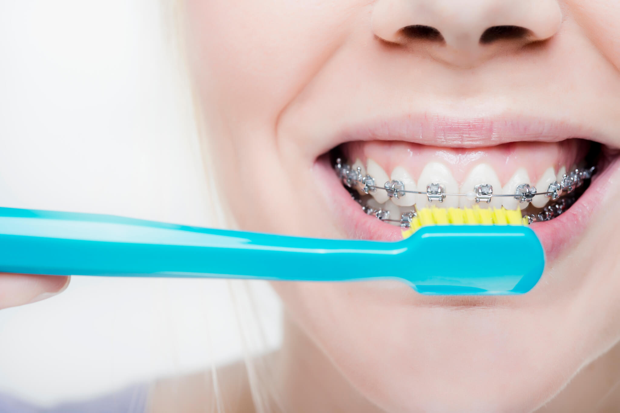 Чистка зубов в нижнем. Щетка для чистки зубов с брекетами. Гигиена полости рта с брекет системой.