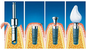 Как устанавливаются импланты зубов пошагово с фото