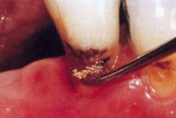 Фото: Лечение кариеса корня зуба