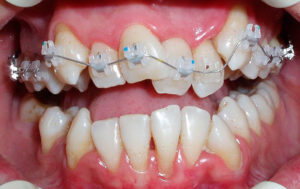 Фото: Процесс коррекции зубов