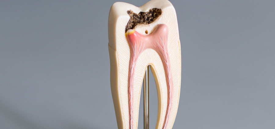 Возможные причины к депульпации зубов