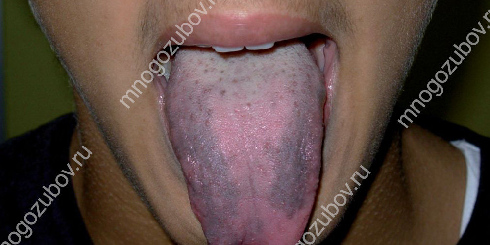 фото: черный язык у пациента