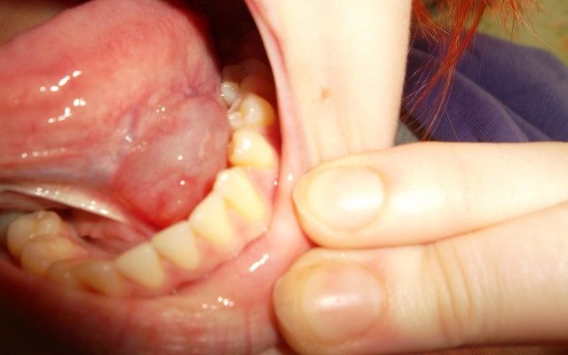 Что делать при воспалении уздечки языка или формировании шишки?