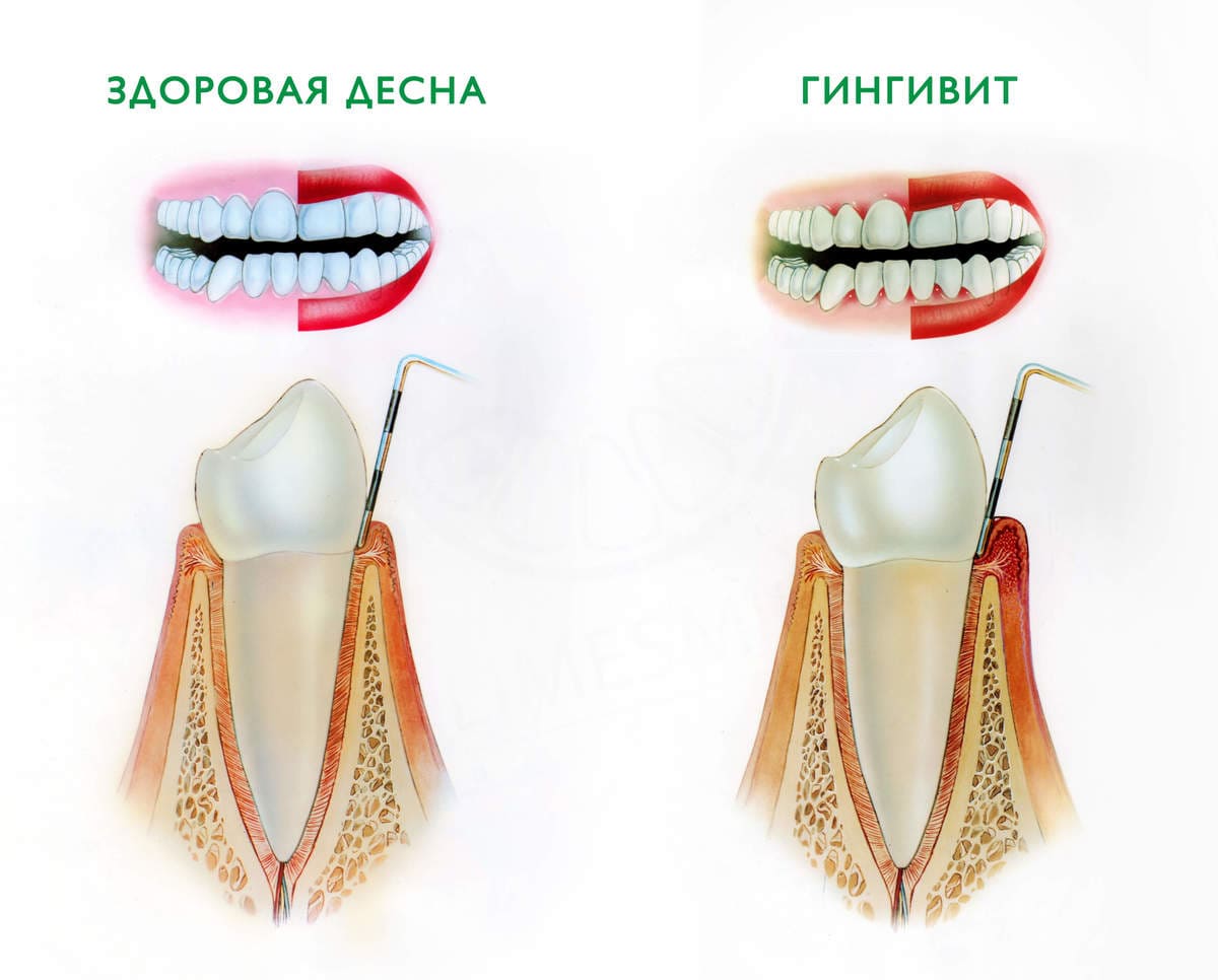 Гингивит