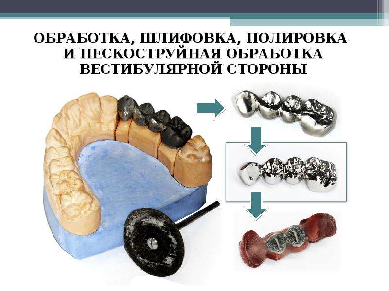 Изготовление цельнолитых протезов. Цельнолитые мостовидные протезы этапы. Паяные мостовидные протезы. Изготовление промежуточной части мостовидного протеза. Цельнолитой мостовидный протез.