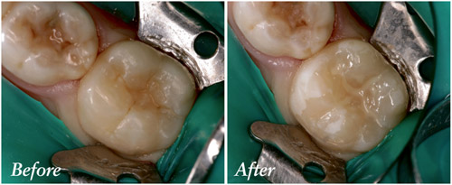 Fissure sealant pictures