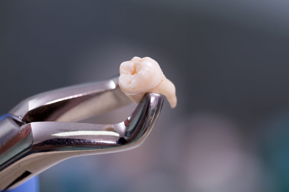 Удаление передних зубов