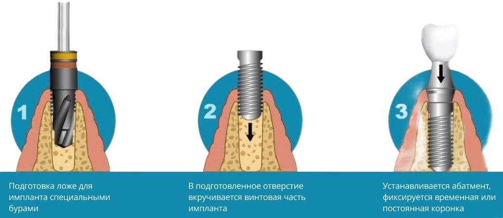 Этапы имплантации зубов схема