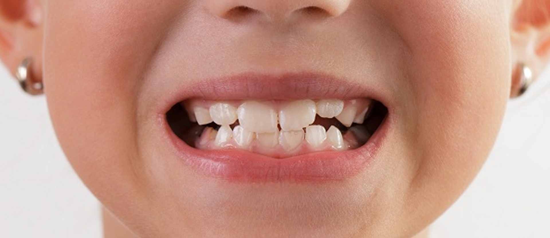 Молочные зубы картинки. Очень кривые зубы у детей.