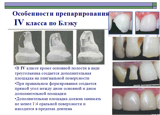 Определение полости. Этапы препарирования кариозных полостей 5 класса по Блэку. Препарирование кариозных полостей 3 класса по Блэку. Препарирование полостей 4 класса по Блэку. Препарирование кариозных полостей 2 класса по Блэку.