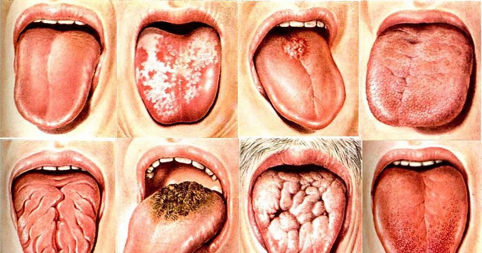 Поговорим о раке языка, или как избежать это заболевание