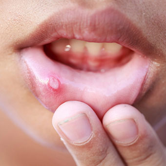 Начальные симптомы рака губы