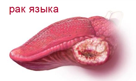 Рак языка