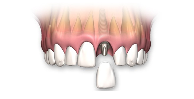 Протезирование переднего верхнего зуба за 1 день
