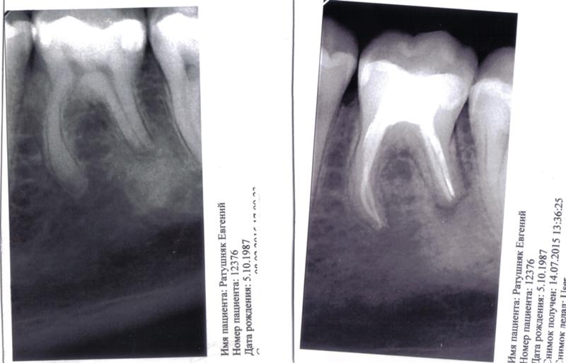Как на снимке выглядит гранулема зуба фото
