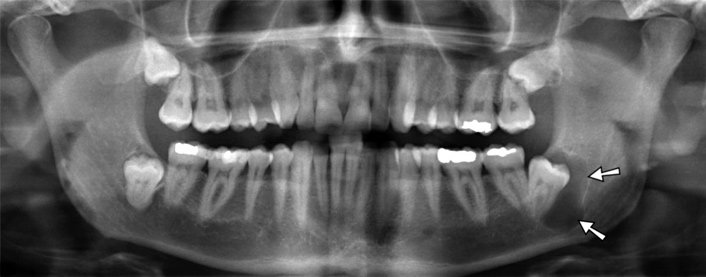 фото киста зуба на рентгене