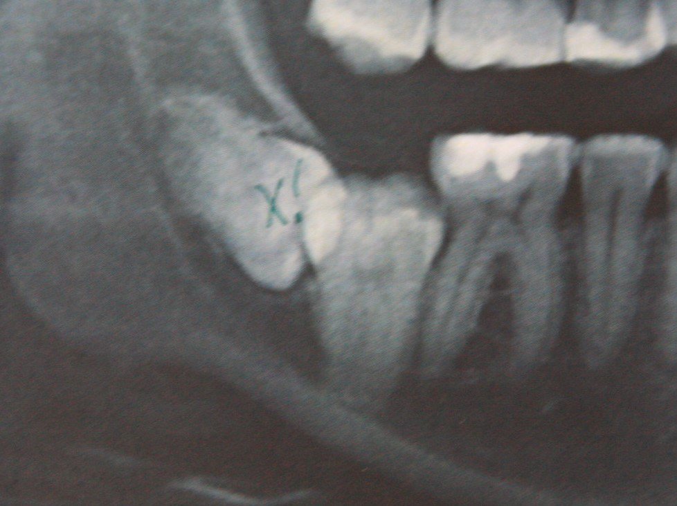 Зуб 8 корень. Ретинированный зуб рентген. Ретинированный зуб мудрости. Ретинированный зуб мудрости рентген. Ретинированный третий моляр.