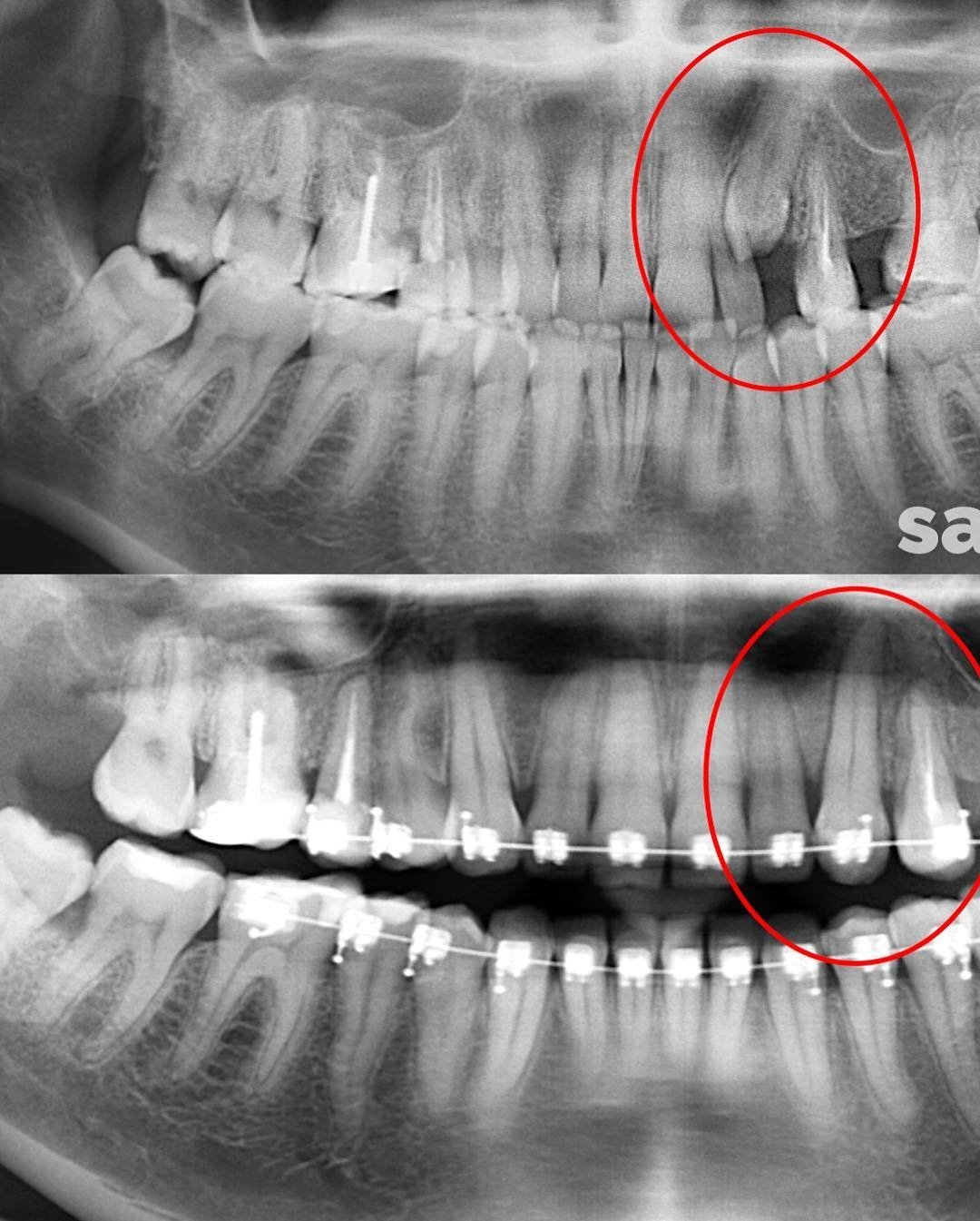 Удаление зуба семерки. Ретинированный зуб мудрости рентген. Ретенированный клык рентген. Ретинированный клык ОПТГ.