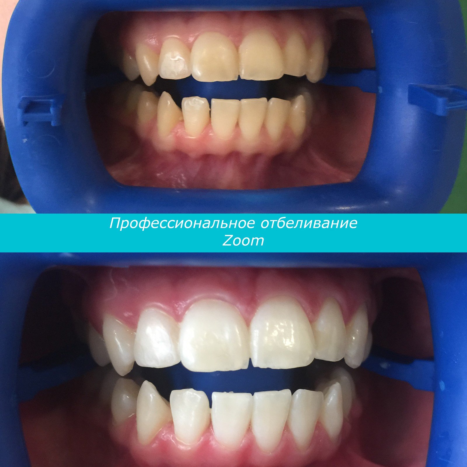 Отбеливание зубов время. Зубы до и после отбеливания.