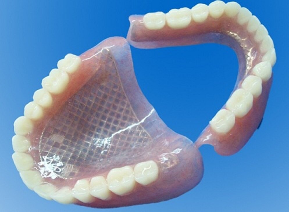 Протез на челюсть без зубов. Протез нейлоновый односторонний (Flexi n512). Частичный съемный протез Flexi n512.