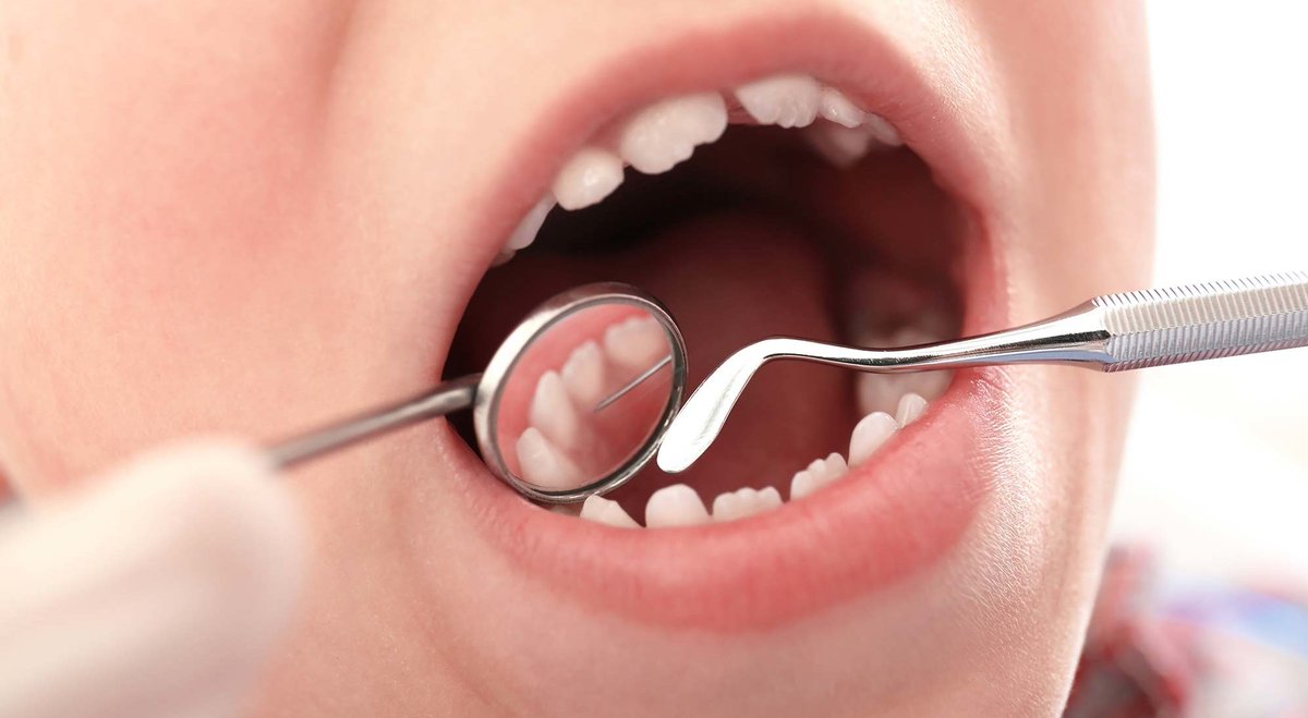 Лечение кариеса зубов у детей