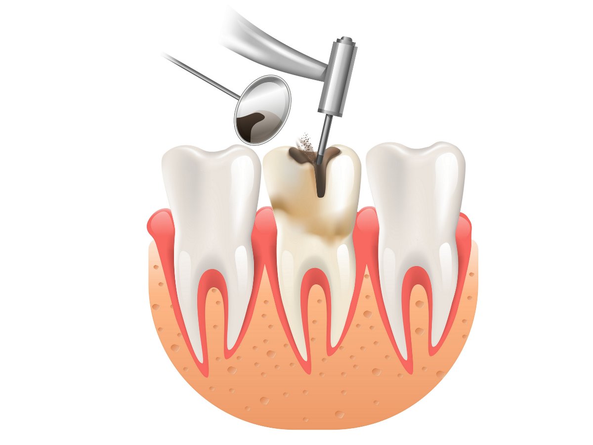 What can the dentist do during root canal treatment?