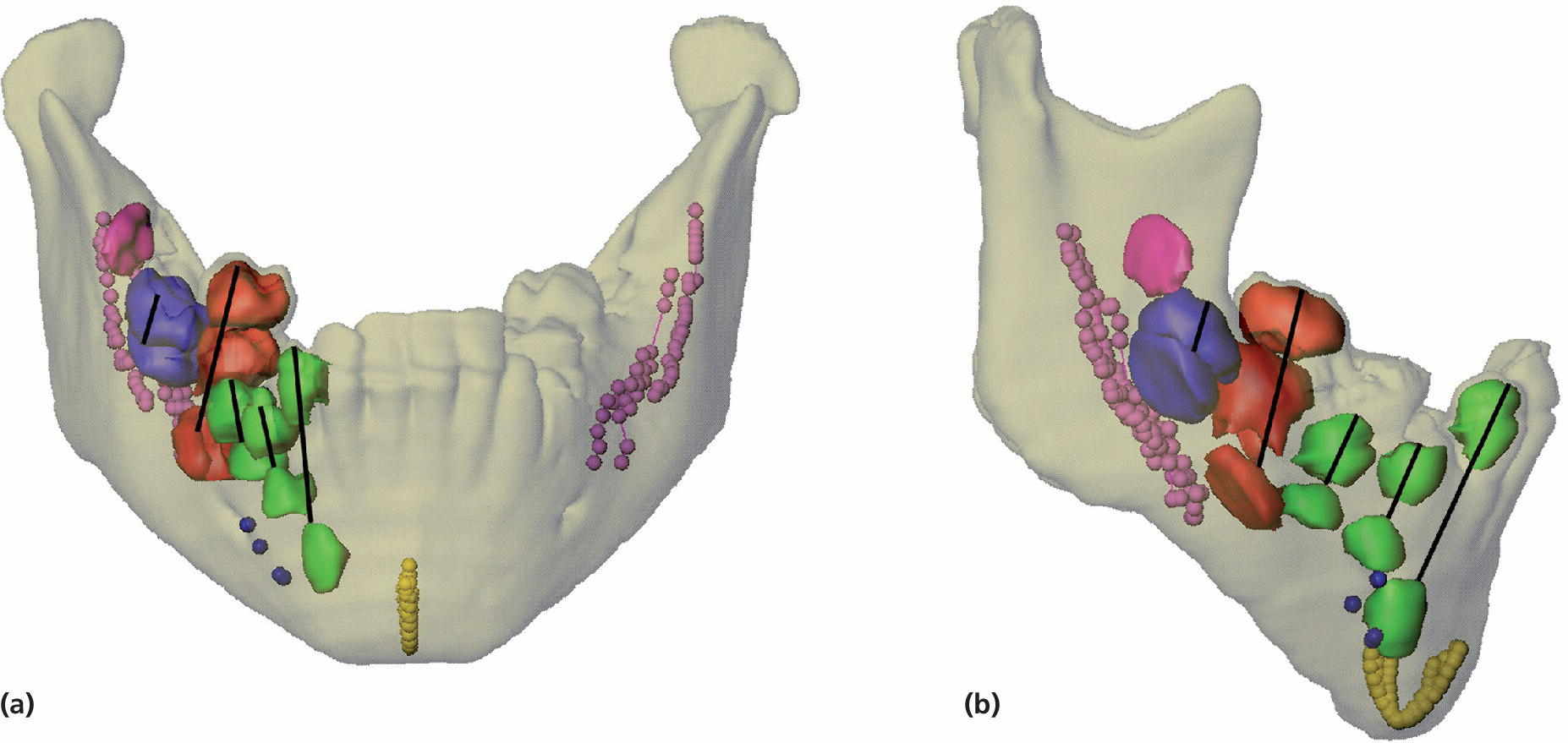 Frontal (a) and lateral views (b) of the transparent mandible, displaying symphysis menti, mental foramen, mandibular canals, and teeth in discrete colors, with lines indicating the eruption paths.