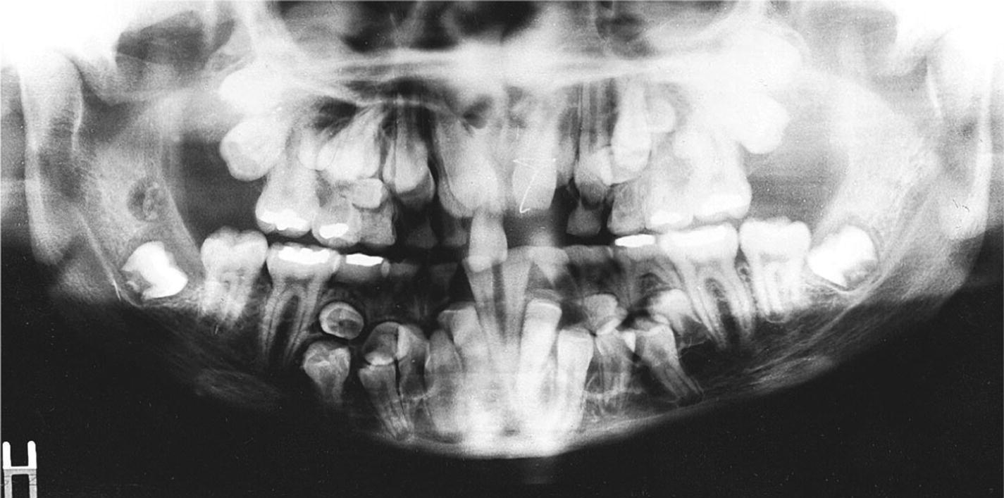 Orthopantomogram displaying supernumerary permanent teeth and arrested eruption of many of the normal permanent teeth of a boy with cleidocranial dysplasia.