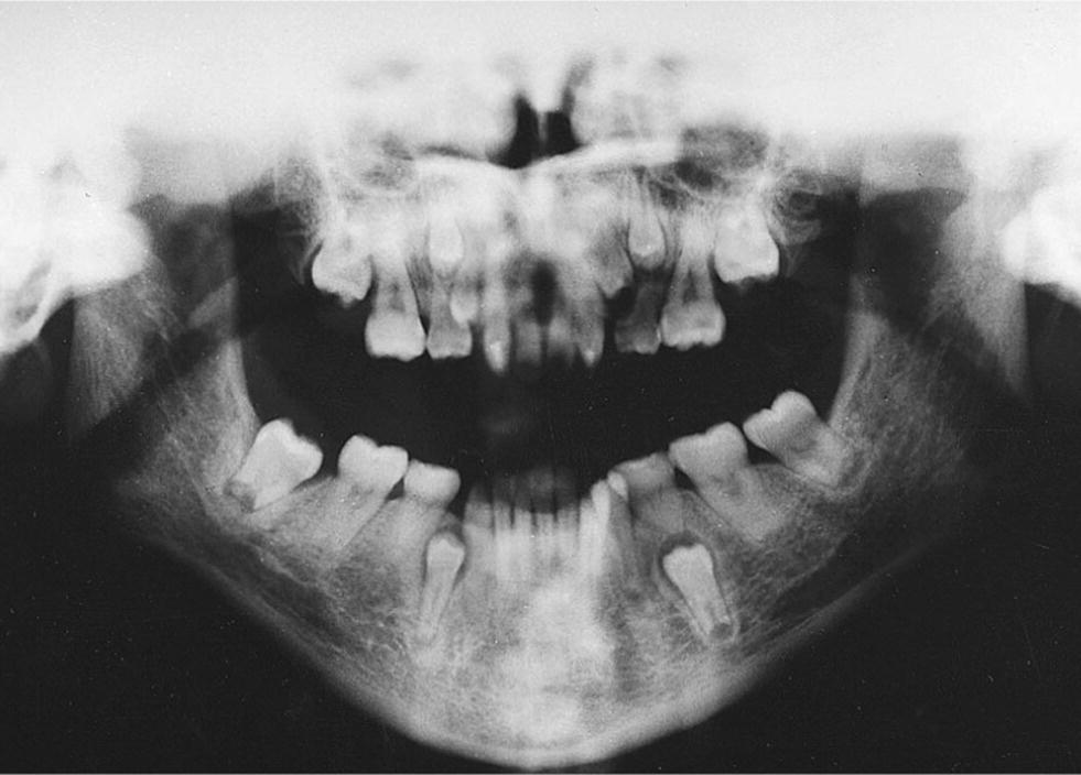 Orthopantomogram displaying severely delayed eruption of several permanent teeth and dense jaw bones of a girl with tricho‐dento‐osseous syndrome.