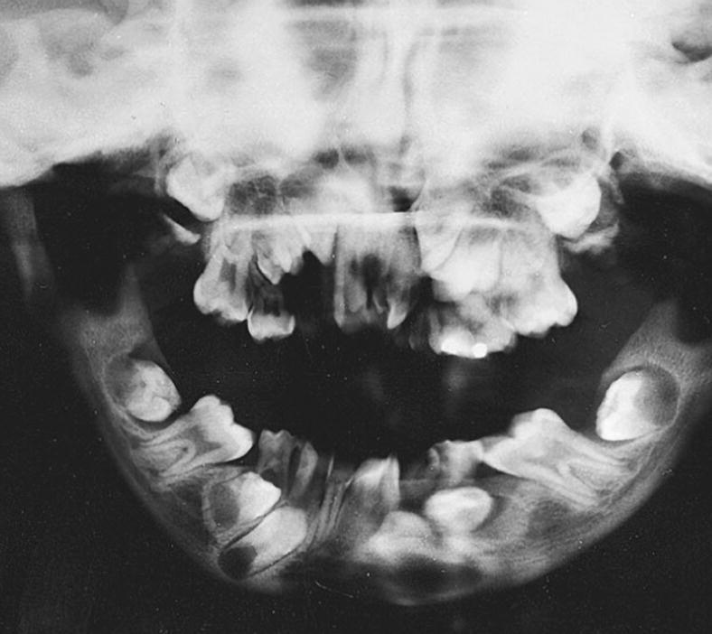Orthopantomogram displaying delayed eruption of several permanent teeth and osteopetrotic bones of a boy with pycnodysostosis.
