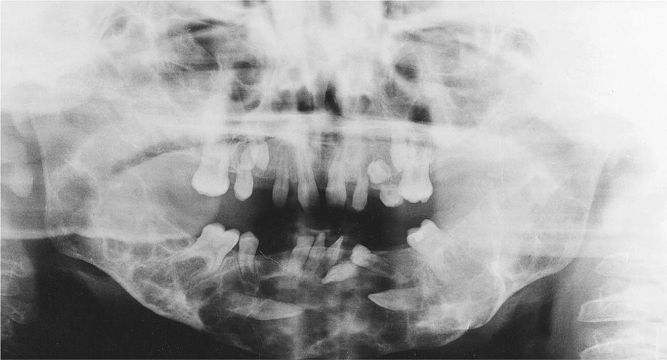 Orthopantomogram displaying large cystic lesions in the maxilla and mandible of a boy with cherubism.